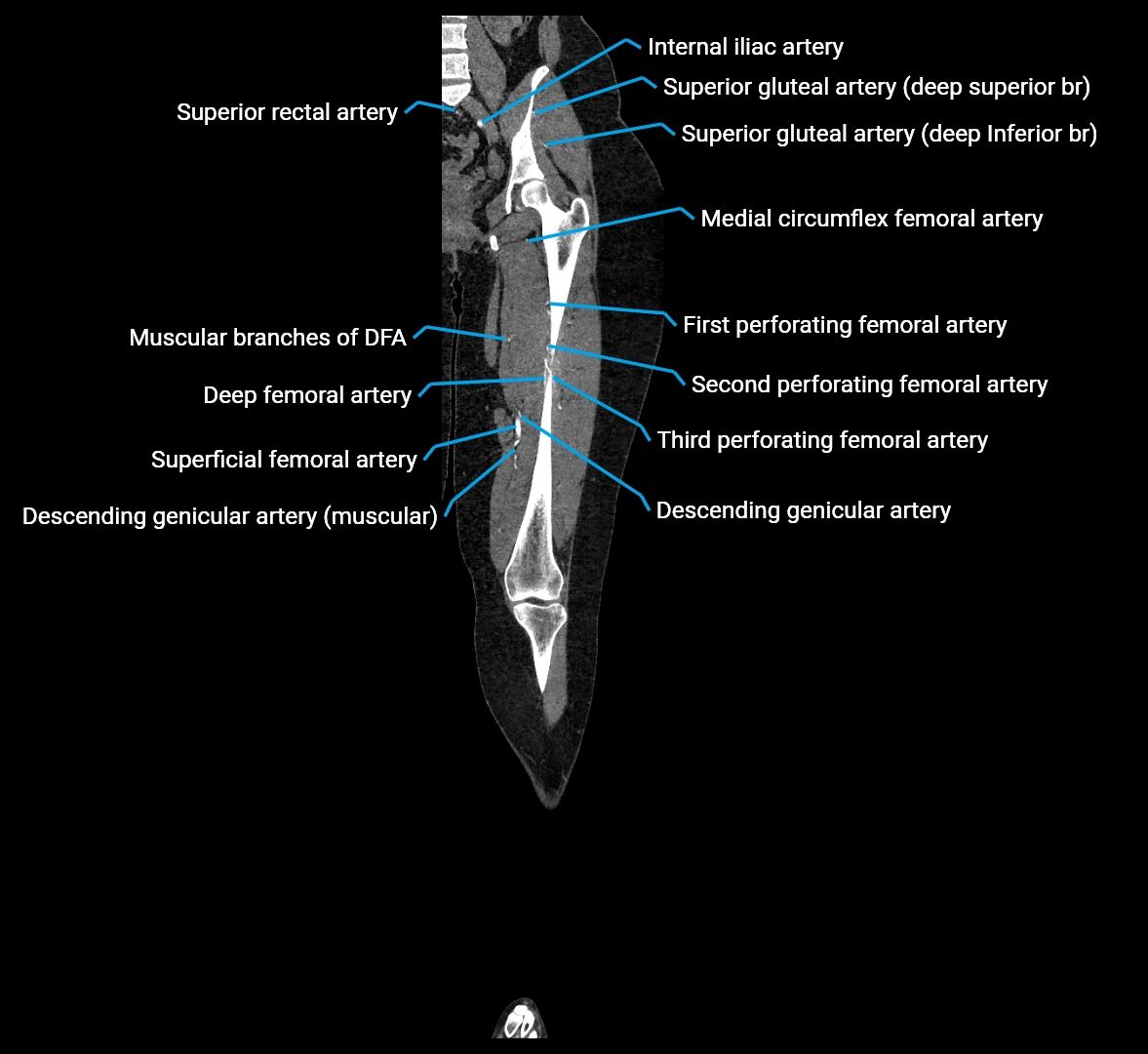 CTA lower limb coronal cross sectional anatomy labelled image _41 (2).webp